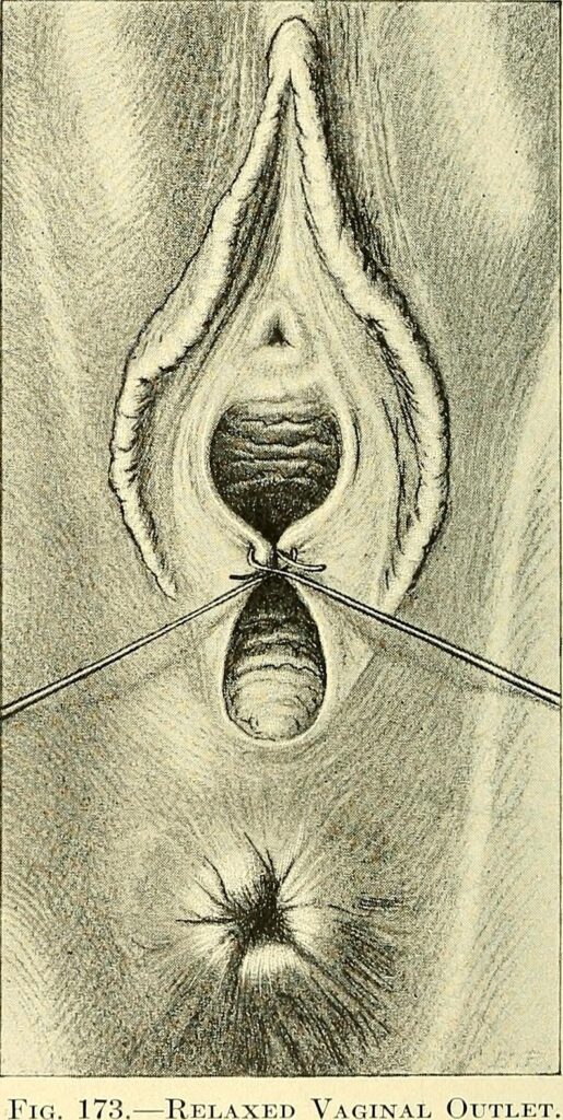 Image from page 325 of "Operative gynecology :" (1906)